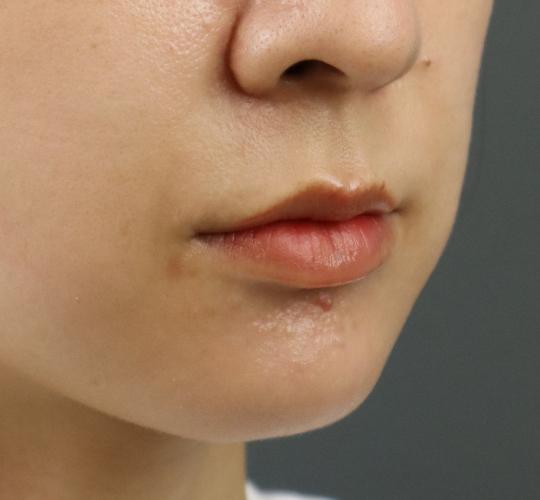 30代女性の人中短縮ボトックス Before 症例写真