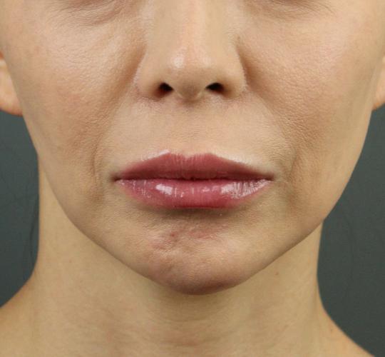 40代女性のヒアルロン酸注射（唇） After 症例写真