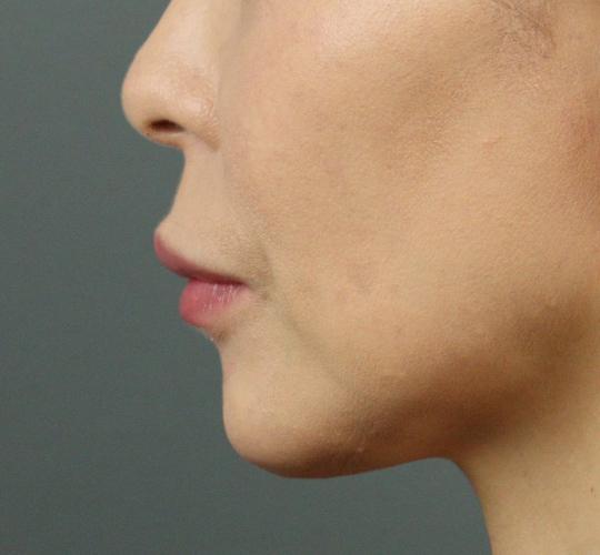 40代女性のヒアルロン酸注射（唇） After 症例写真