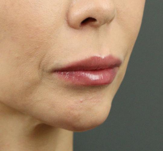 40代女性のヒアルロン酸注射（唇） After 症例写真