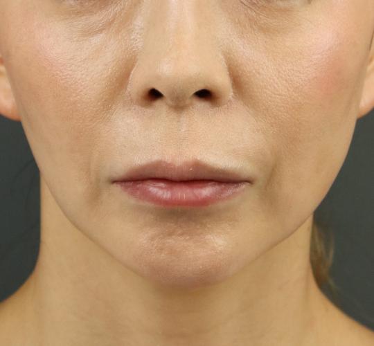 40代女性のヒアルロン酸注射（唇） Before 症例写真