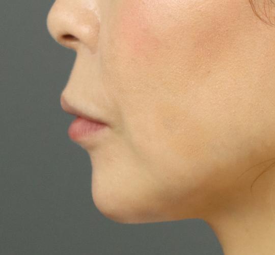 40代女性のヒアルロン酸注射（唇） Before 症例写真