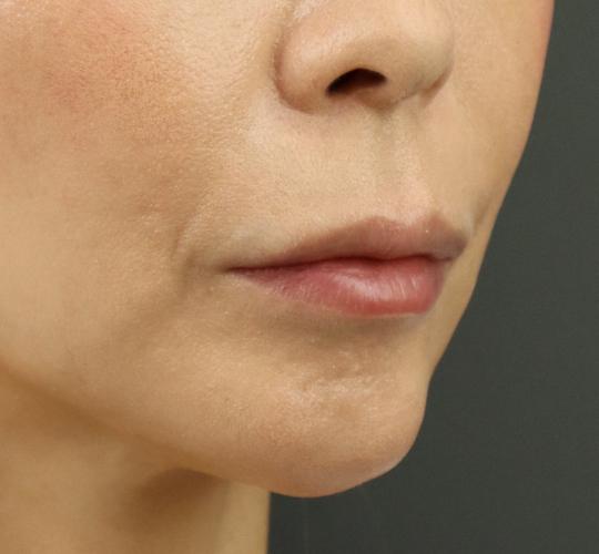 40代女性のヒアルロン酸注射（唇） Before 症例写真