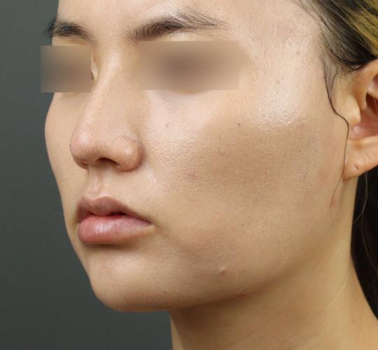 20代女性のヒアルロン酸注射（アゴ形成） After 症例写真