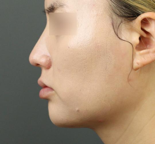 20代女性のヒアルロン酸注射（アゴ形成） After 症例写真