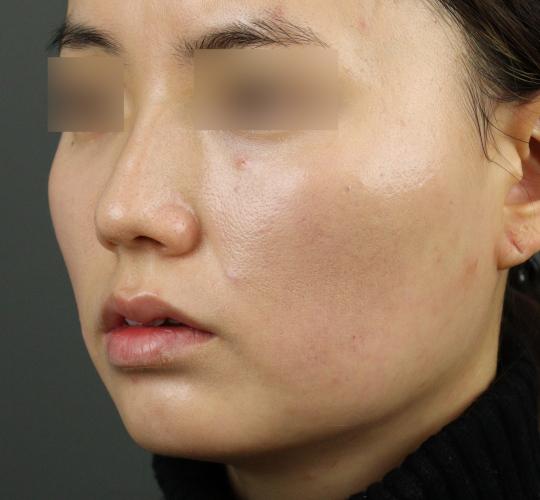 20代女性のヒアルロン酸注射（アゴ形成） Before 症例写真