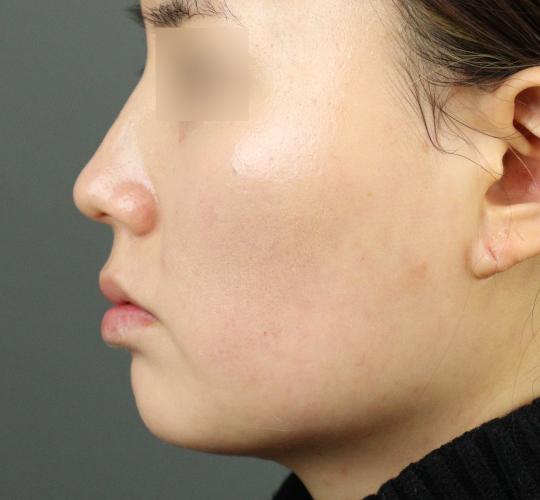 20代女性のヒアルロン酸注射（アゴ形成） Before 症例写真