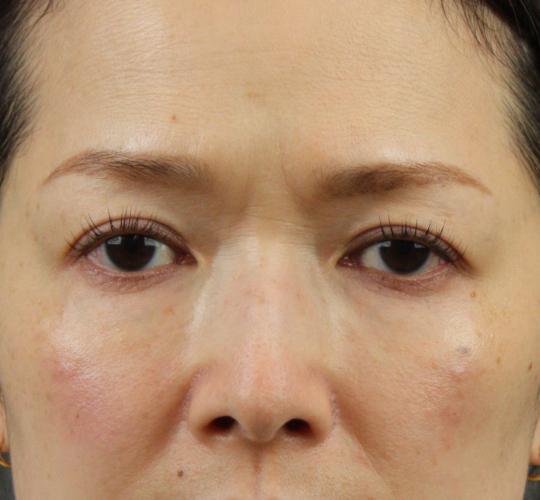 40代女性のヒアルロン酸注射（目の下） After 症例写真