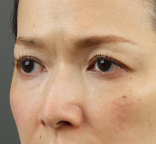 40代女性のヒアルロン酸注射（目の下） After 症例写真