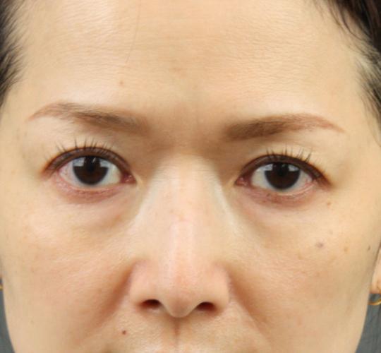 40代女性のヒアルロン酸注射（目の下） Before 症例写真