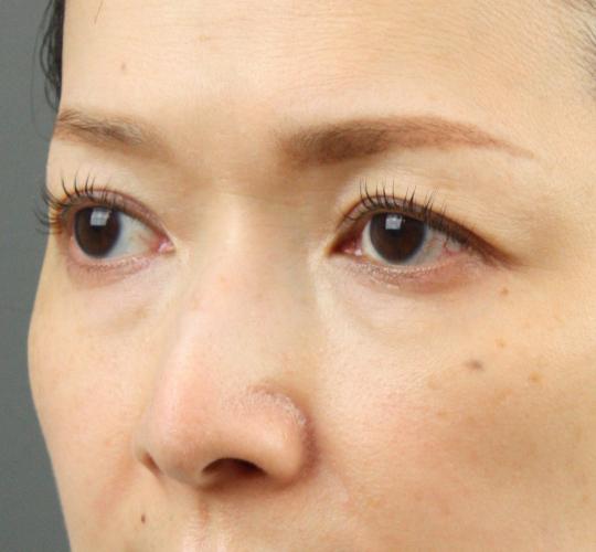40代女性のヒアルロン酸注射（目の下） Before 症例写真