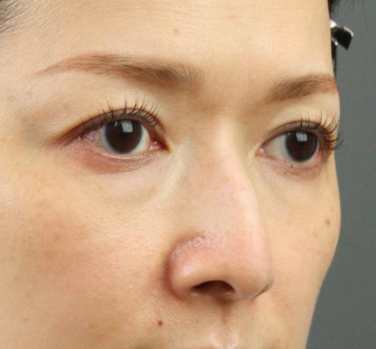 40代女性のヒアルロン酸注射（目の下） Before 症例写真