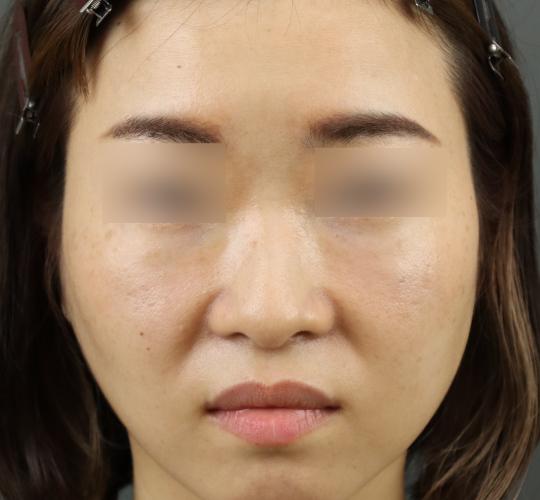 30代女性のヒアルロン酸注射（ゴルゴライン） After 症例写真