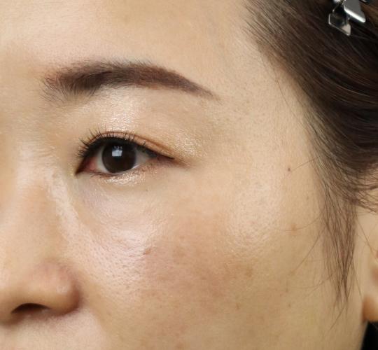 30代女性のヒアルロン酸注射（ゴルゴライン） After 症例写真