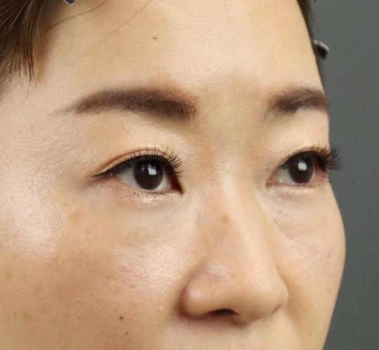 30代女性のヒアルロン酸注射（目の下） After 症例写真