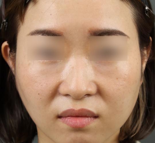 30代女性のヒアルロン酸注射（ゴルゴライン） Before 症例写真