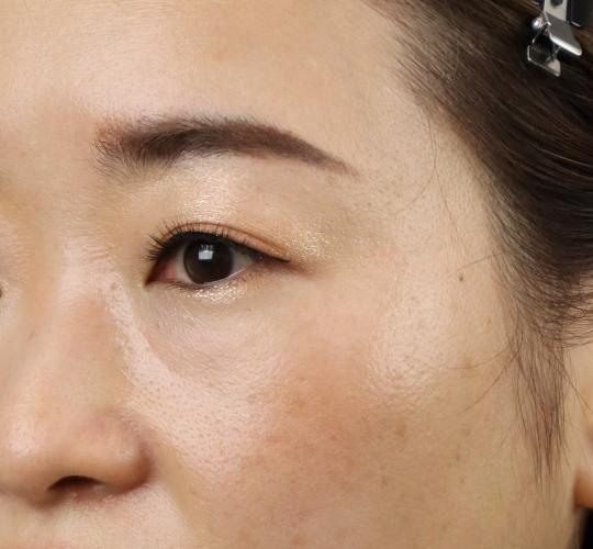 30代女性のヒアルロン酸注射（ゴルゴライン） Before 症例写真