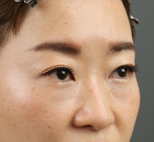 30代女性のヒアルロン酸注射（目の下） Before 症例写真