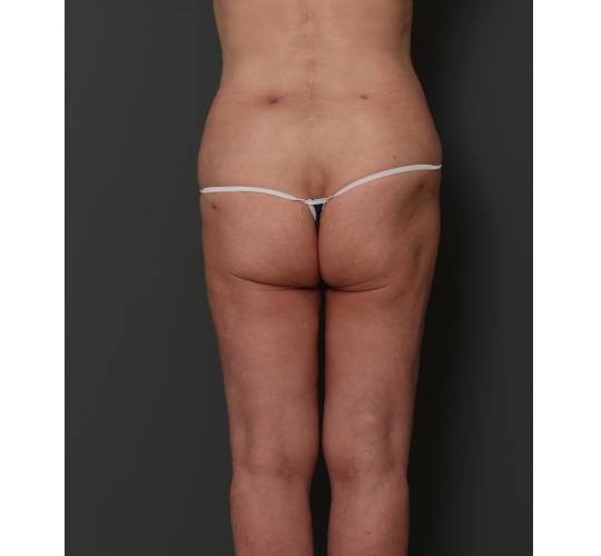 50代女性の脂肪幹細胞培養豊胸 After 症例写真