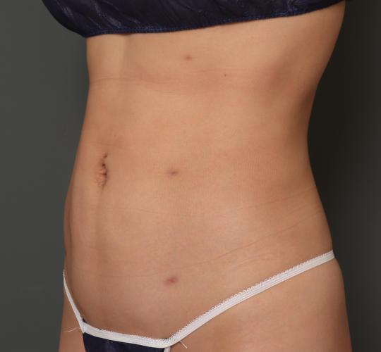 30代女性の脂肪吸引 After 症例写真