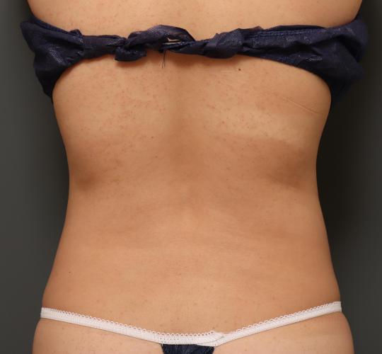 30代女性の脂肪吸引 Before 症例写真