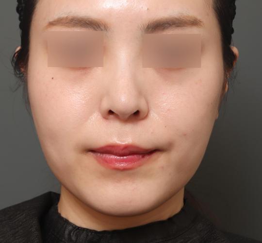20代女性の顔の脂肪吸引  After 症例写真
