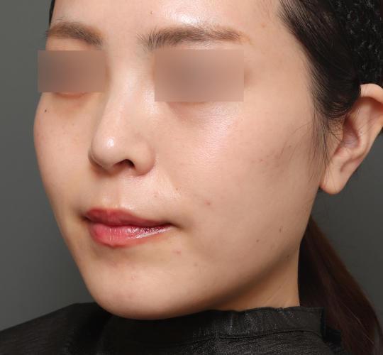 20代女性の顔の脂肪吸引  After 症例写真