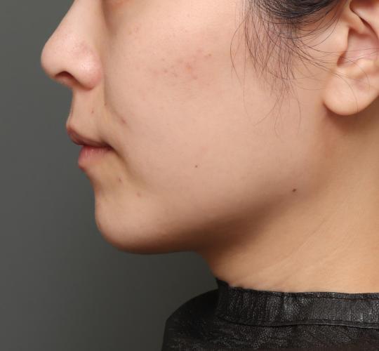 20代女性の顔の脂肪吸引 After 症例写真