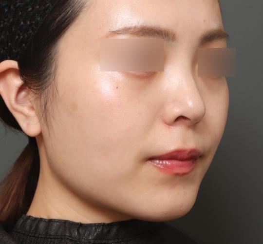 20代女性の顔の脂肪吸引  After 症例写真