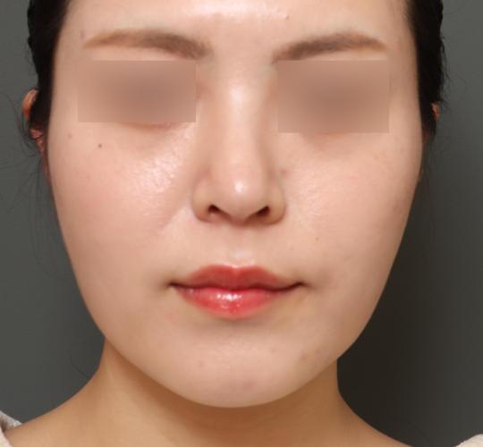 20代女性の顔の脂肪吸引  Before 症例写真