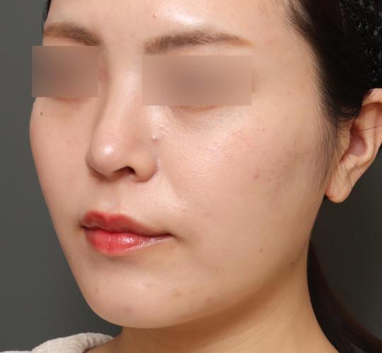 20代女性の顔の脂肪吸引  Before 症例写真