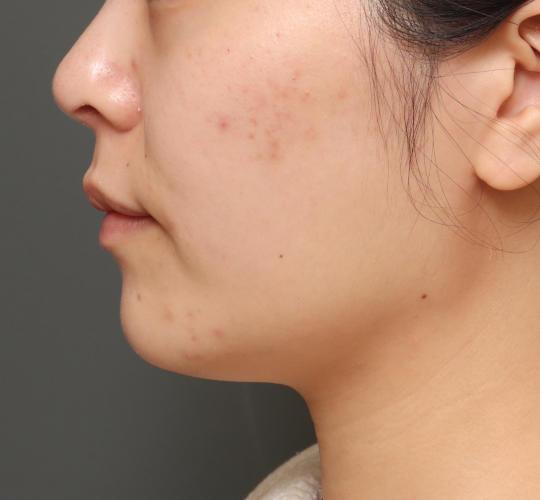 20代女性の顔の脂肪吸引 Before 症例写真