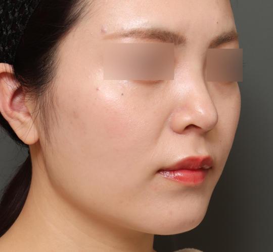 20代女性の顔の脂肪吸引  Before 症例写真