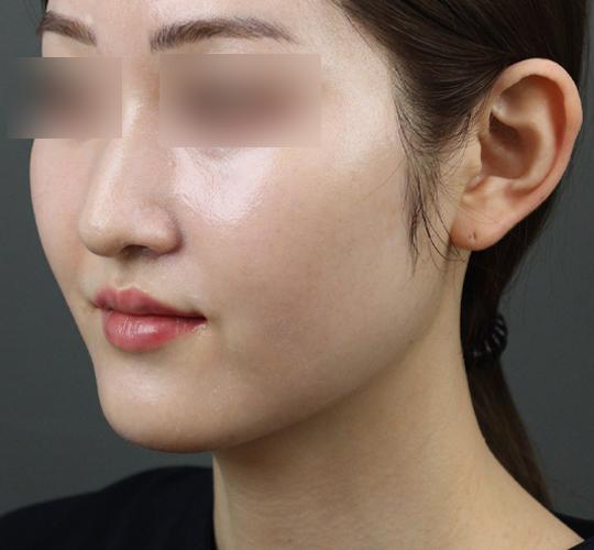 20代女性のヒアルロン酸注射（唇） After 症例写真