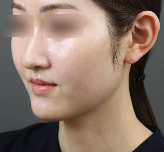 20代女性のヒアルロン酸注射（唇） Before 症例写真