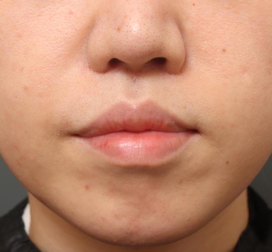 30代女性の鼻翼拳上 After 症例写真