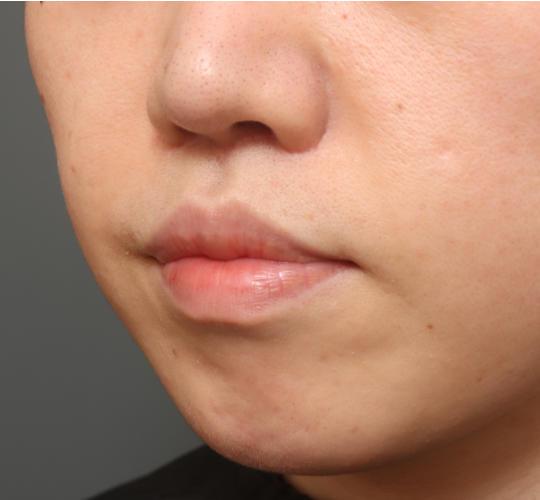30代女性の鼻翼拳上 After 症例写真