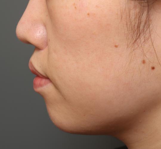 30代女性の鼻翼拳上 After 症例写真