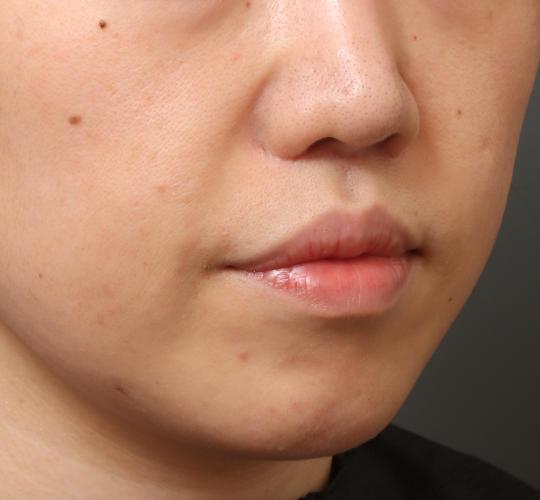 30代女性の鼻翼拳上 After 症例写真