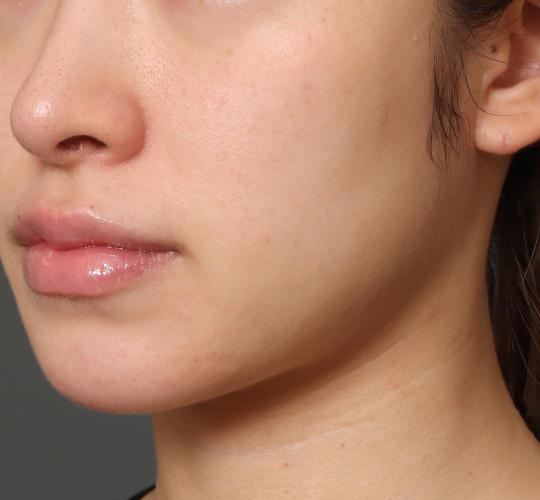 20代女性のグロウHIFUセレクトプラス After 症例写真