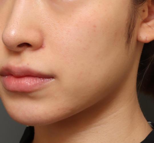 20代女性のグロウHIFUセレクトプラス Before 症例写真