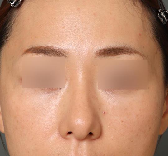 40代女性のハムラ法（目の下のたるみ取り） After 症例写真