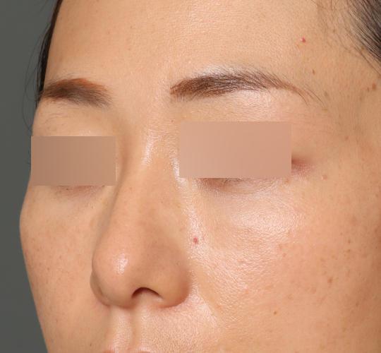 40代女性の3Dリポアイリフト  After 症例写真