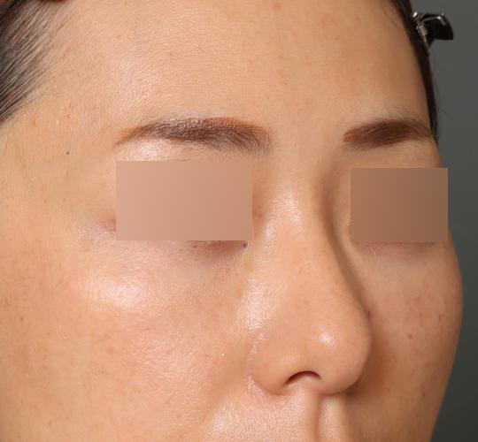 40代女性の3Dリポアイリフト  After 症例写真