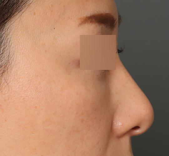 40代女性の3Dリポアイリフト  After 症例写真