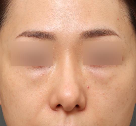 40代女性のハムラ法（目の下のたるみ取り） Before 症例写真