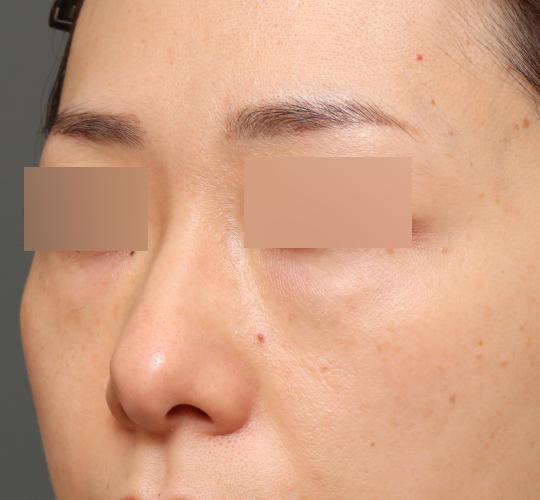 40代女性の3Dリポアイリフト  Before 症例写真