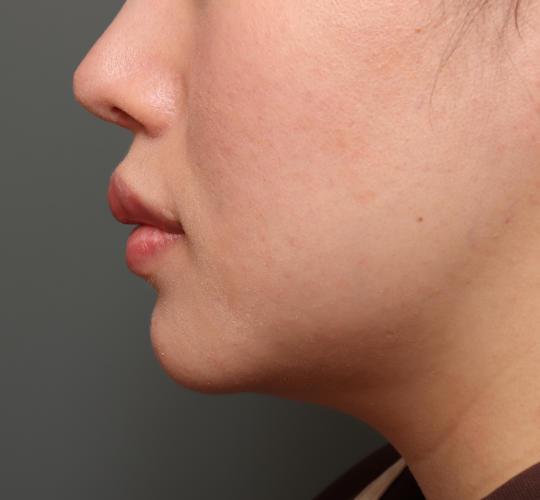 20代女性の二重アゴ筋肉縛り（ペリカン手術） Before 症例写真