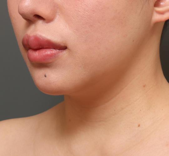 20代女性の二重アゴ筋肉縛り（ペリカン手術） Before 症例写真