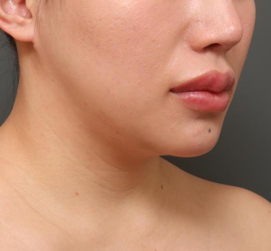 20代女性の二重アゴ筋肉縛り（ペリカン手術） Before 症例写真